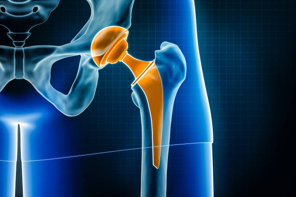 Hip Replacement Surgery